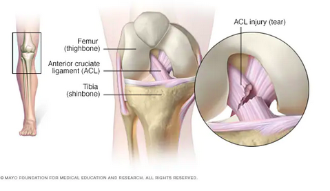 A model of an injury to the ACL.